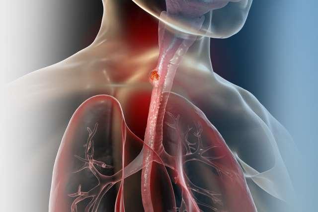 Esophageal cancer, 3D illustration showing malignant tumor in the human esophagus