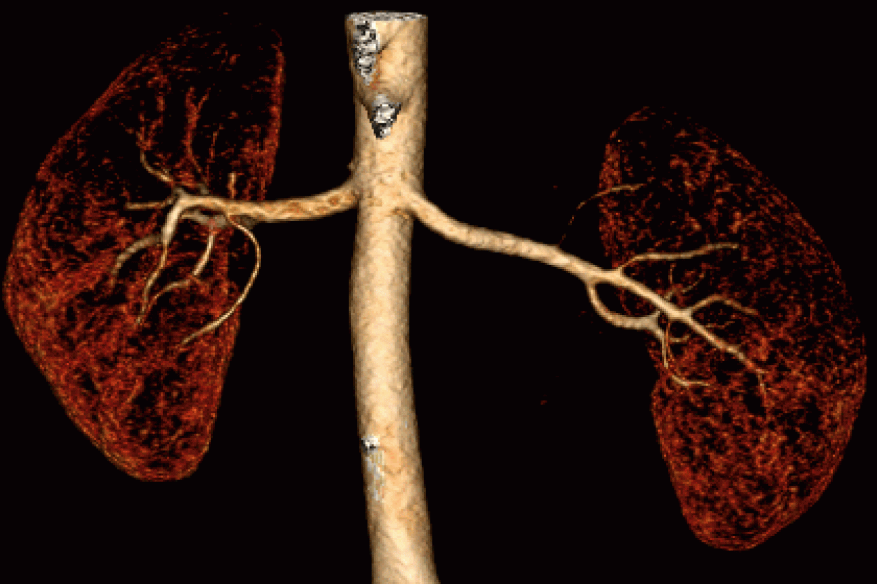 Q3D Lung Animation